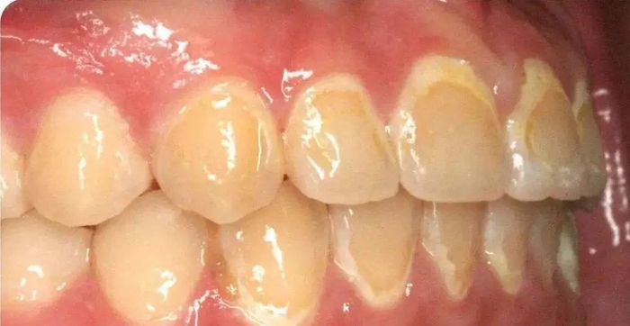 如何预防牙齿脱矿？